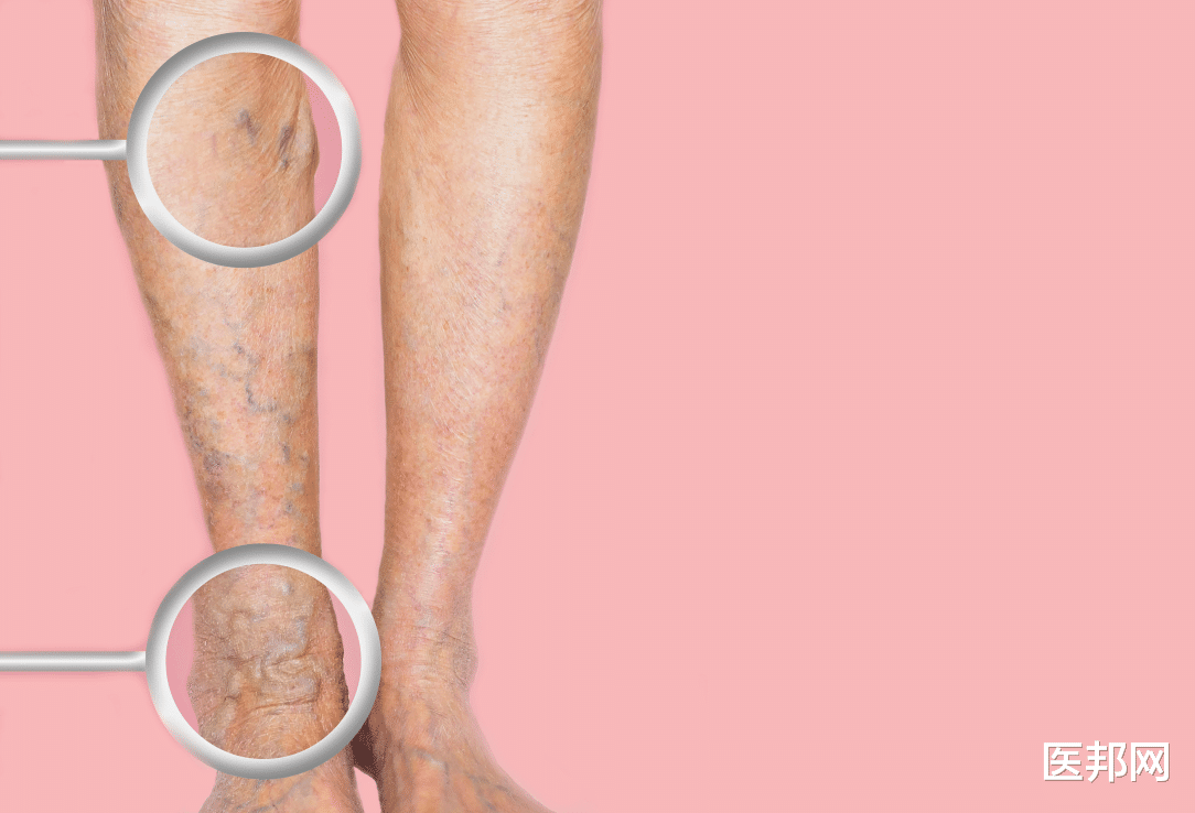 静脉曲张|可以治愈静脉曲张的唯一方法,也有微创了,最佳治疗时机别错过