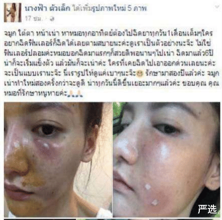 严选|“慎打”美白针！有女生惨遭毁容：不存在真正意义的美白针啊
