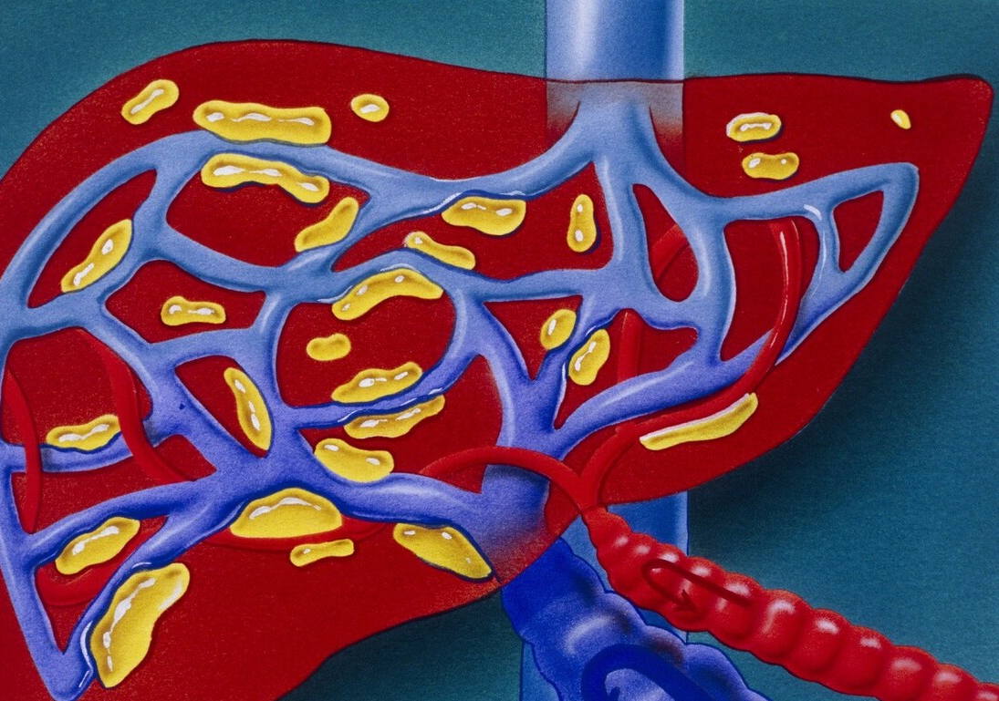 降压药|这些行为，或会加速肝硬化，尽快改正，把肝硬化“拦在门外”