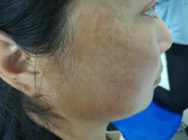 臀部|年龄越大越容易长斑？建议：45岁后，3种食物要舍得吃，或能养肤