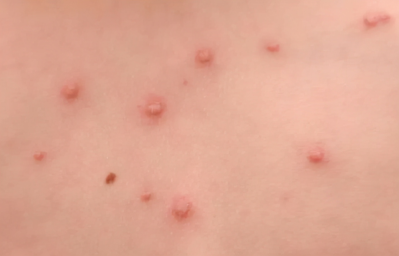 宫颈癌|双腿是宫颈癌的“警报器”，有3个异常，宫颈多半已“破败不堪”