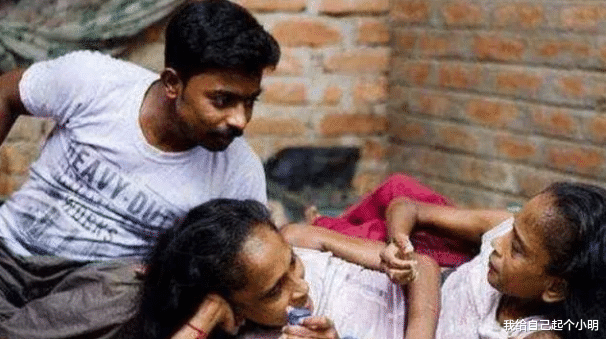  印度连体姐妹共用下肢，嫁给了同一位男子，还生了一个孩子