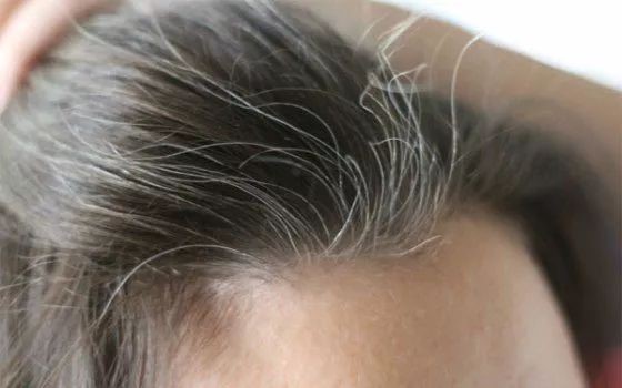 清克颜究所|惜丝：不同白发不同原因，要想正确“赶走”白发，看这篇！