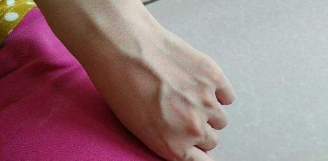 脑梗|肝不好了，手和脚有变化，5种常见美食，吃多了却很伤肝