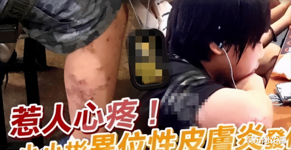 司藤|小小彬正当红时赚1800万，长残后无戏可拍，如今得病皮肤溃烂