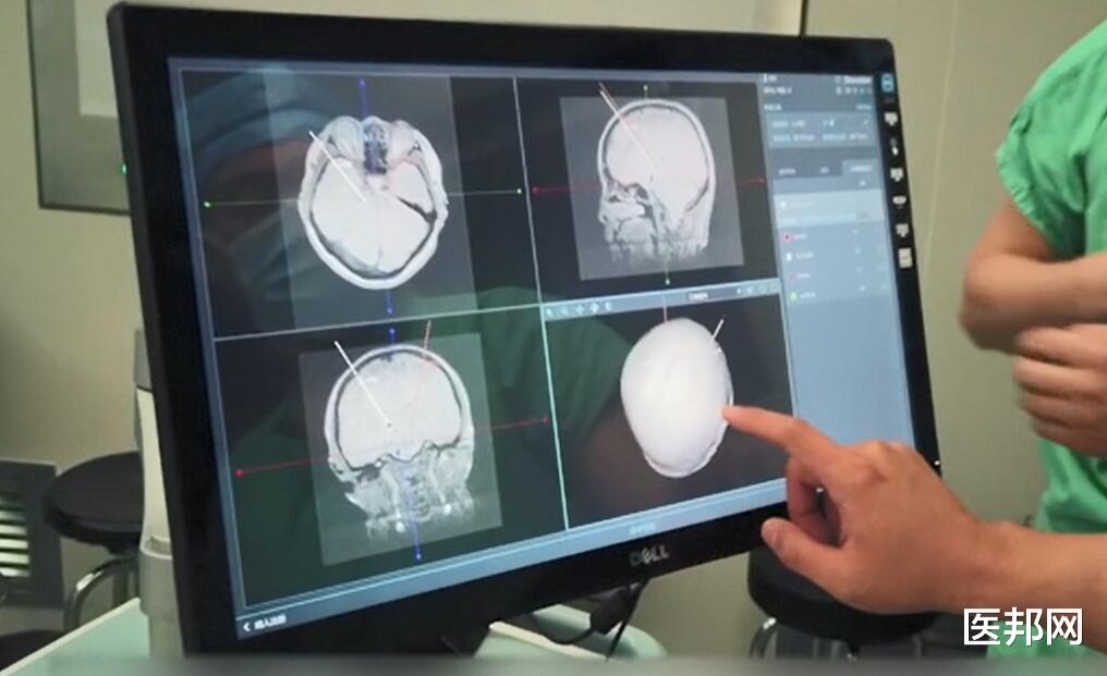 医生|帕金森病怎么治疗最好？医生坦言，首选治疗方案是这个