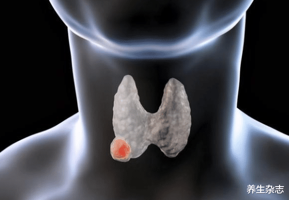 甲状腺癌|48岁男子咳嗽不止，甲状腺癌晚期，医生：身体3异常，预示癌细胞转移