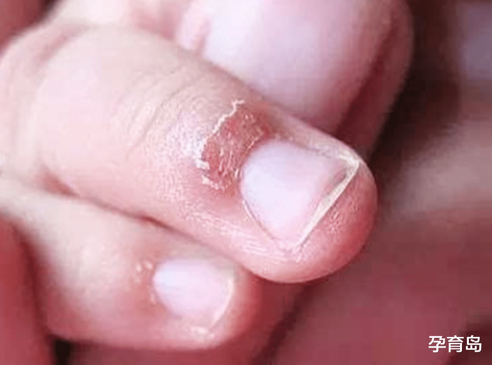 孕育岛|孩子的手总起倒刺，可能不是缺乏维生素，而是在提醒该做这件事了