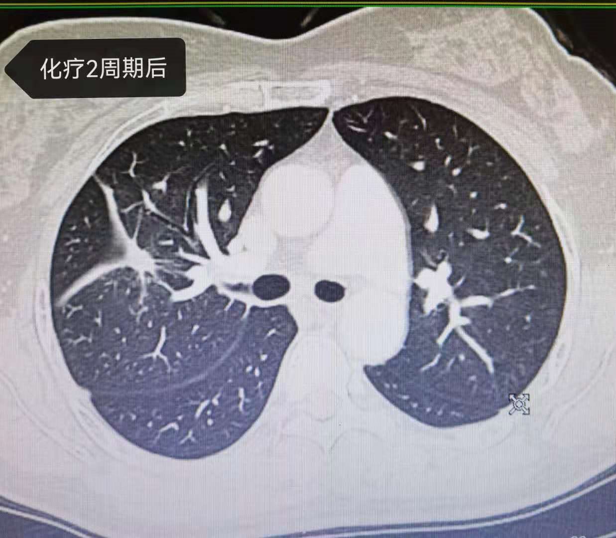 用户_胡洋|靶向耐药，45岁晚期肺癌病人使用化疗联合抗血管生成药物效果显著！