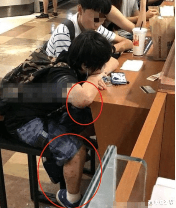 尹正|2岁出道，承担后妈整容费，今17岁患皮肤病，父亲却不给打针？