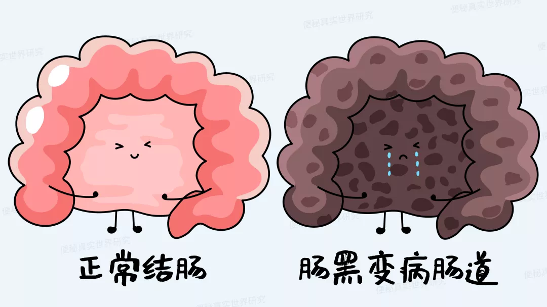 便秘|女子喝通便茶肠子变黑,谨慎使用这类泻剂!