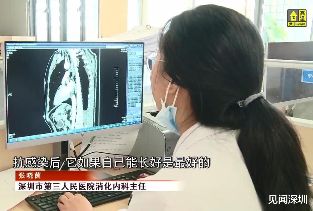 见闻深圳 教训啊!深圳男子硬吞鱼刺致食管破裂危及生命,多次CT检查无果