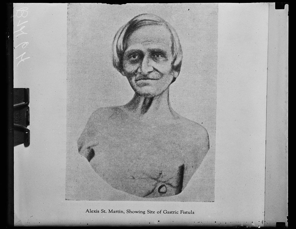 博蒙特 在胃上开个洞？8年完成238次人体实验，如今造福了全人类