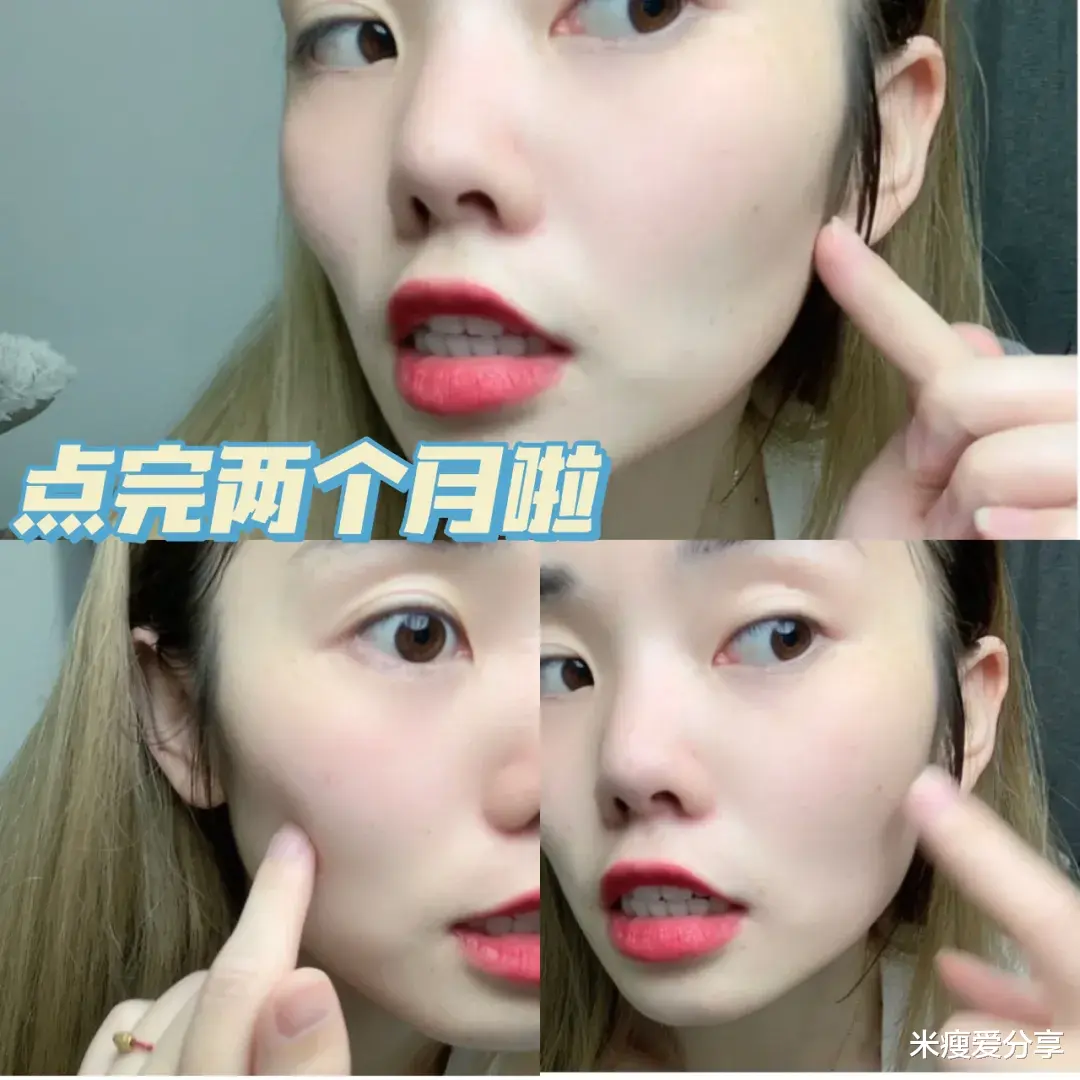 米瘦爱分享|药水点痣两个月的心得笔记，顺便解答最关心的三个问题！