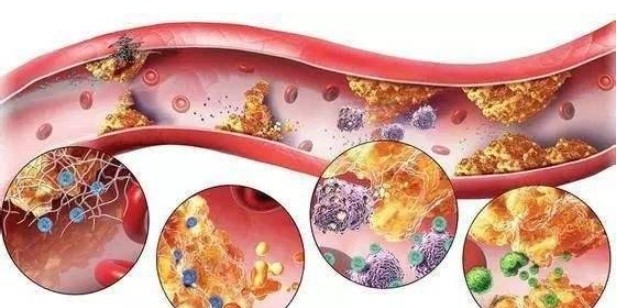 山楂|天然“溶脂剂”被发现,并非山楂,平时敞开喝,降脂溶栓,血管畅通无阻