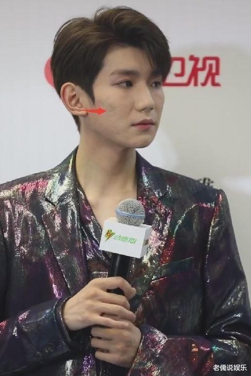 王源|王源 去年夏天青春痘已经让脸变形 现在是否还好?