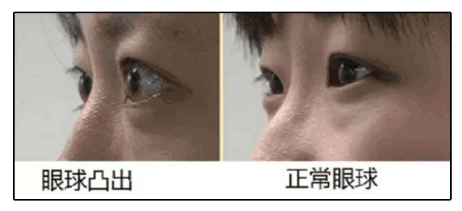 近视|那些近视不戴眼镜的人，最后都成什么样了？