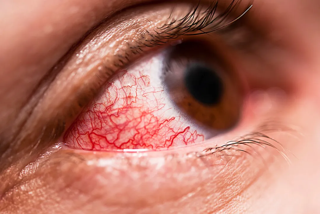 中牟眼健康|眼睛红肿、眨眼频繁？疫情期间，小心这几种病找上门