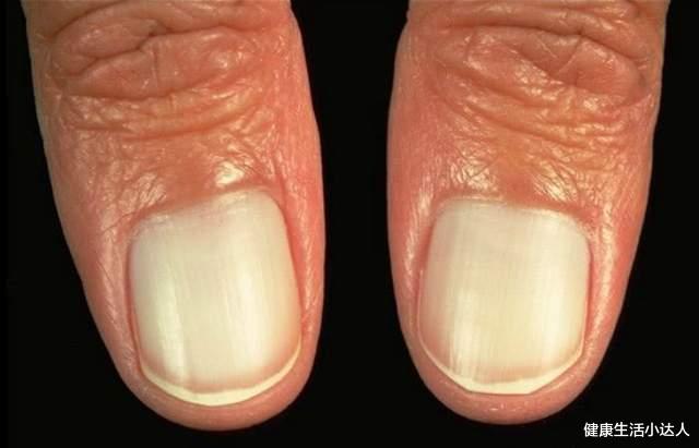 高血压|肝出了问题,身体三个地方有“反应”,及早调养,切莫拖成癌