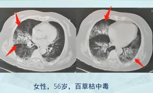 百草枯|29岁男子百草枯中毒死亡记录：当他后悔时，家人却决定放弃治疗