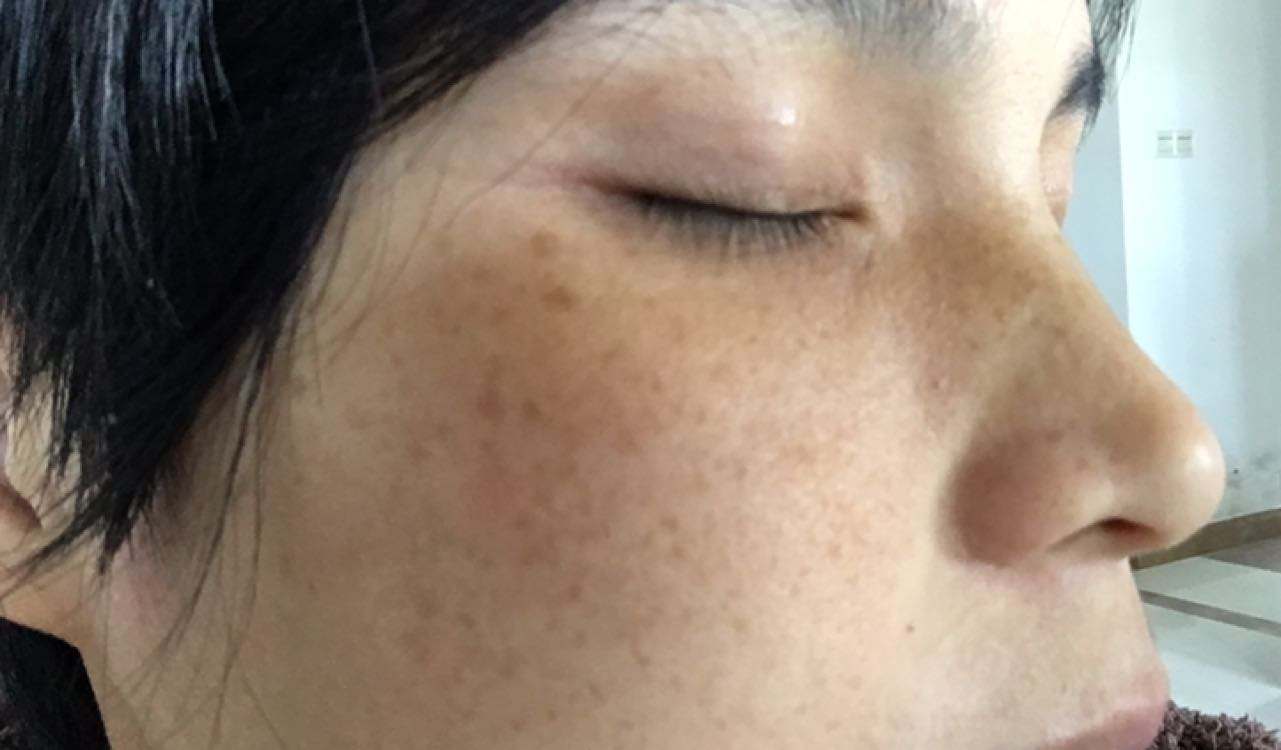黑色素|臉上長斑下不去，皮膚科：與4個壞習慣有關，現在改還來得及