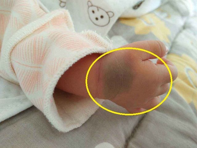 西红柿妈妈|为何有些新生儿会有“胎记”？可能跟孕妇的习惯有关，要管住自己