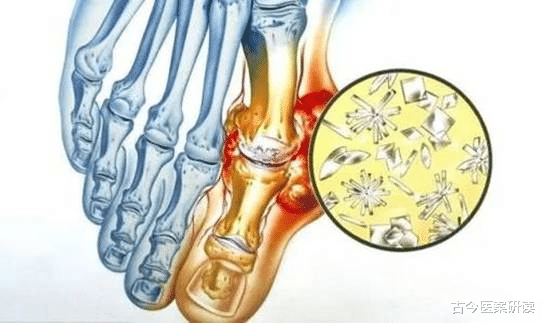 痛风|痛风大多是“拖”出来的，医生提醒：出现“2多2疼”，赶紧调理，防止肾脏衰竭