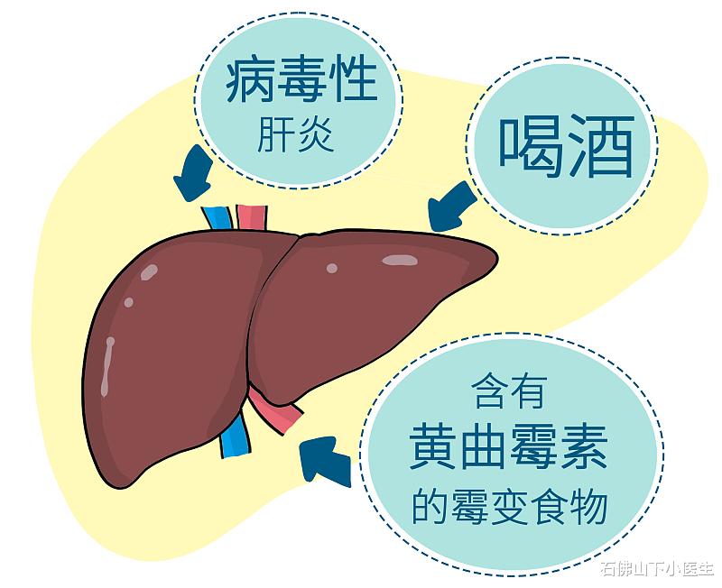 石佛山下小医生|肝癌早期可能有哪些症状？