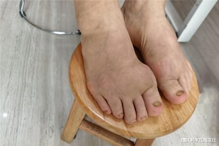 痛风科朱红梅主任 痛风为什么需要定期复诊？这几个痛风定期复诊的重要性你都知道了吗？