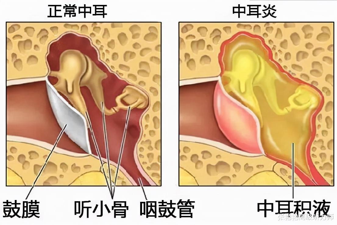 张艳艳高级听力师 中耳炎不能拖，听力损失还不是最严重的结果