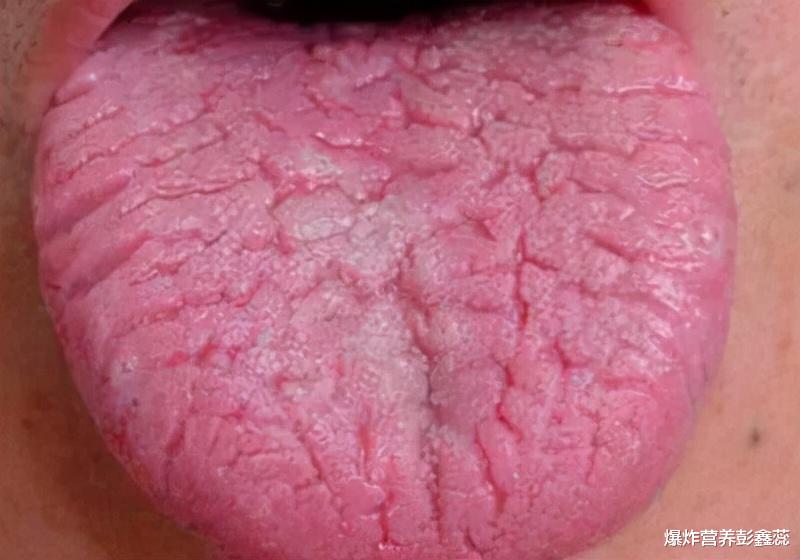 按摩|舌头上出现裂纹是什么原因?舌头有这3种现象,都在反映健康问题