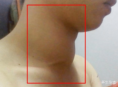 医生|一家三口接连确诊甲状腺癌,医生摇头:煮粥爱放1物,铁打的甲状腺也扛不住