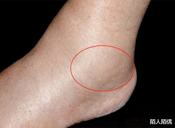 中药|肾不舒服的男人，手脚有3处现象，多喝1种水，排毒素还养肾！