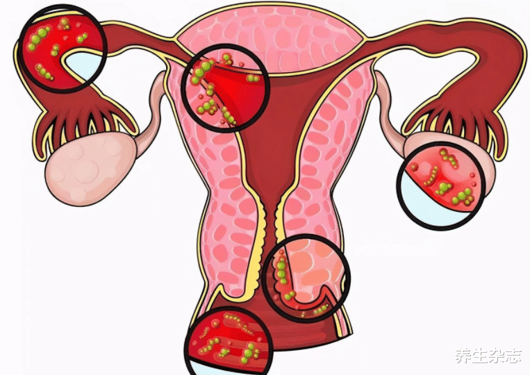医生|17岁高三女生查出HPV，母亲查出宫颈病变，医生：是你害了孩子