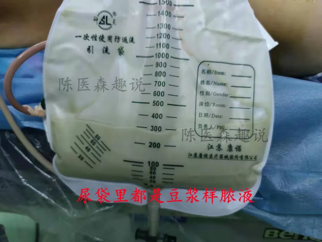 肝脏|得了肾结石，一定要经常体检，不然......