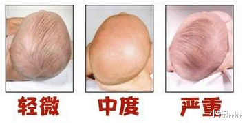 小特麻麻|头型影响颜值？如何帮助宝宝睡出完美头型？