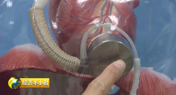 环球Tech “中国造”全磁悬浮人工心脏轻至180克：商用落地时间暂不确