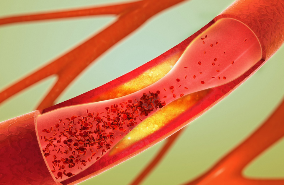 血栓|天然“溶栓药”找到了，早晚随便吃2口，清血栓防脑梗，血管不堵塞