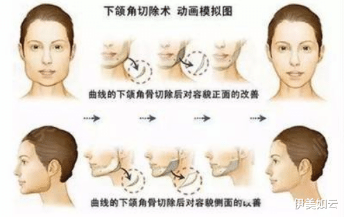 伊美如云|磨骨“无所不能”？必知的磨骨术的五大危险