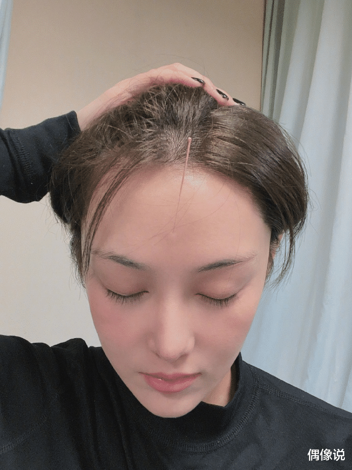 蔡少芬|三胎妈妈蔡少芬晒病床针灸照，画面揪心，感慨：当妈妈不容易