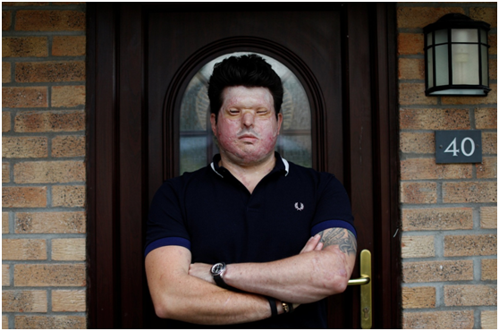 睹图 一家4口在家遭抢劫，男主人还被泼硫酸毁容，事后对方却说认错人