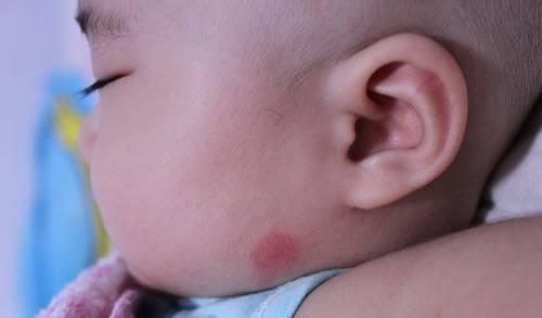 我是妈妈|夏季蚊虫叮咬,家长少给宝宝喷花露水,使用不当容易“引火上身”