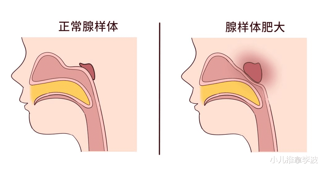 小儿推拿李波|小儿推拿李波：为何孩子割了腺样体却还是流鼻涕、鼻塞、打鼾呢？