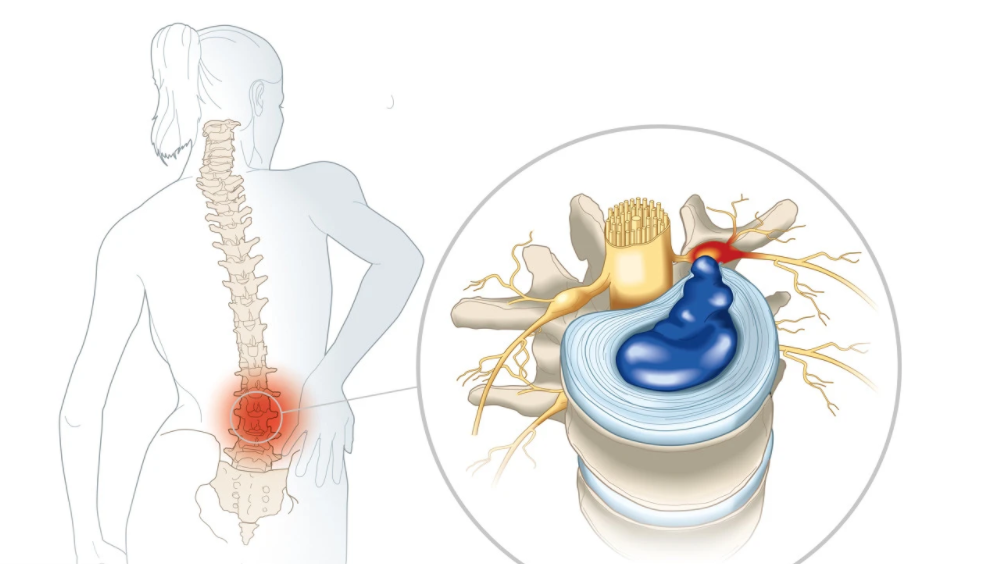 蜂蜜|臀部并伴随双侧大腿疼痛剧烈、跛行，可能是腰椎间盘脱出引起的！