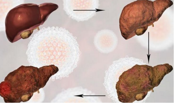 肝脏|肝不好，脚先知？医生提醒：双脚出现3种“异常”，尽早去做肝功检查