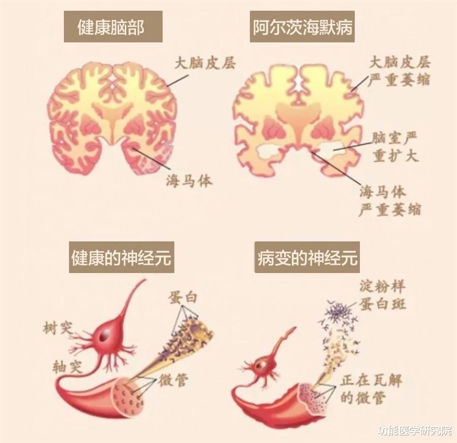 功能医学研究院|万亿阿尔茨海默病市场，与智能化特色防治方案
