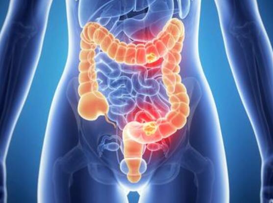 排便|大肠开始癌变时，“便便”会有3种表现，排便时，要多留心一下