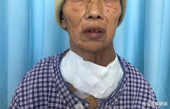 |甲状腺疾病悄悄缠身？厨房的3种用具都是“罪魁祸首”，别再使用