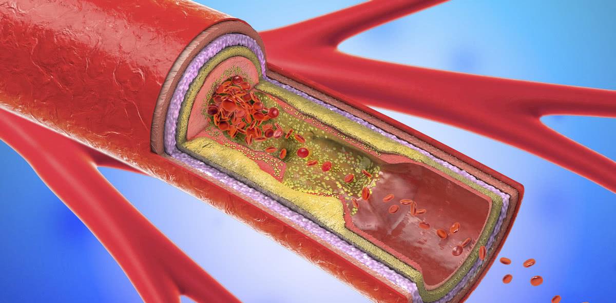 甘油|甘油三脂由6.3降到1.6，煤老板分享经验：多吃一物，血管慢慢通透
