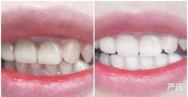 严选 刷牙前牙刷要沾水吗？很多人不了解，所以牙齿会变黄